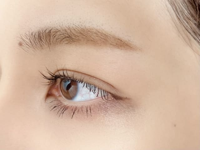 施術後に二重のラインに左右差が生じる主な理由